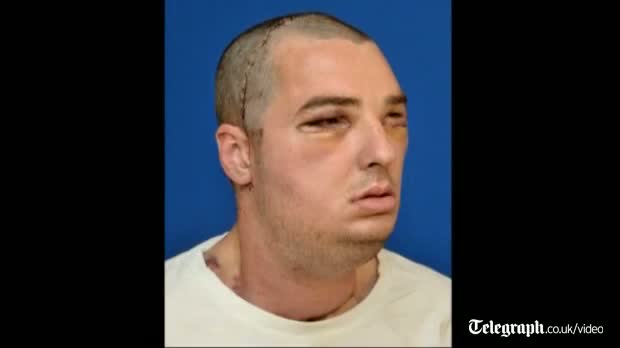 US gun injury victim receives 'most extensive full face transplant ever' video