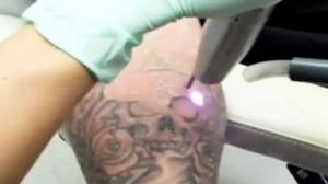Amazing Half Sleeve Laser Tattoo Removal