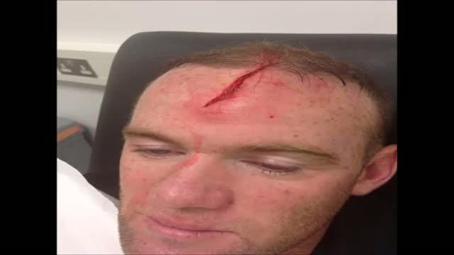 Wayne Rooney Awful Head Injury