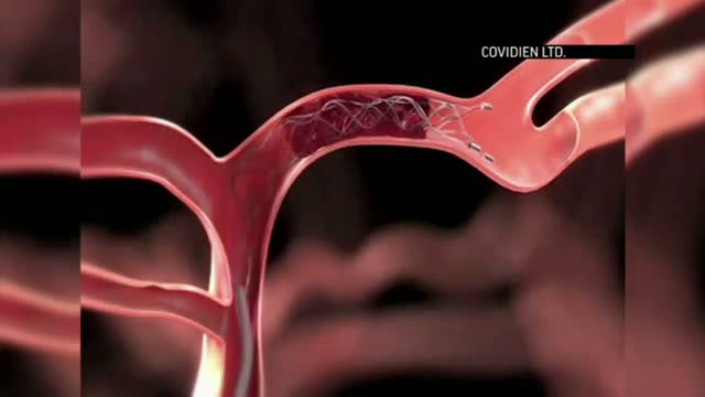 Brain Stents Show Promise for Stroke Patients Video
