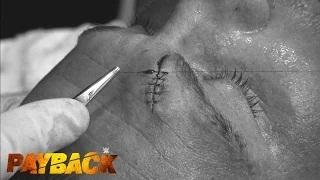 Dolph Ziggler receives stitches after his match at WWE Payback