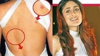 Bollywood celebs caught with deadly Lovebites