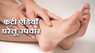 Cracked Heels Remedies in Hindi by Sonia Goyal