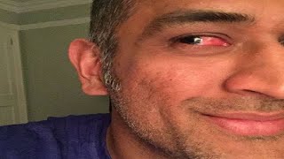 Dhoni injures eye during a match against Zimbabwe in third T20