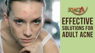 Effective Solutions For Adult Acne- Dr. Shehla Aggarwal (Dermatologist)