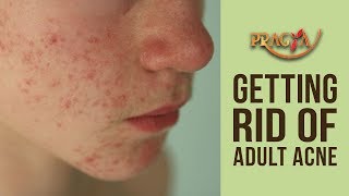 Skin Care- How To Get Rid Of Adult Acne- Dr. Shehla Aggarwal (Dermatologist)