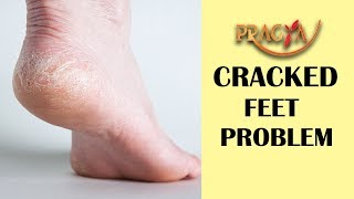 Cracked Heels Treatment | Dr. DM Mahajan (Dermatologist)
