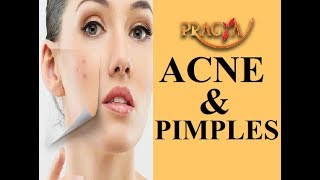 Get Rid of Acne & Pimples Payal Sinha (Naturopath Expert)