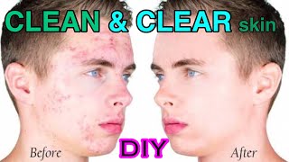 Boys Special - DIY Astringent for Clear, Spotless Skin | Get rid of Pimples, Open Pores