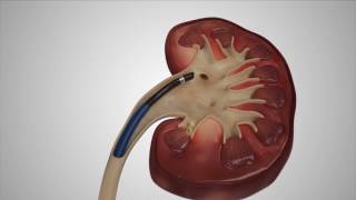 Kidney Stones: Causes, Symptoms & Cure - Ep2