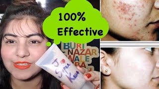 How To Remove Pimples - DIY Neem Face Wash | Teenage Skin Care | Pimples Remedy | Jsuper Kaur