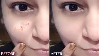 How to Remove Pimples - 100% Effective Acne treatment | JSuper Kaur