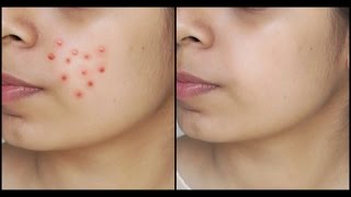 How to : Get Rid of Acne Permanently | All about Skincare Series - 1