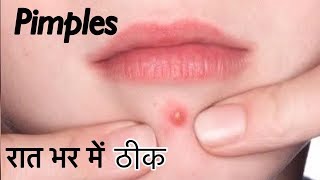 Pimples ka ilaaj 100% | How to Remove Acne overnight | Pimples treatment at home | JSuper Kaur