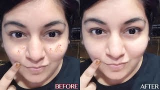 Pimples Remedy - DIY Acne Toner | How To Get Rid of Pimple & Acne | JSuper Kaur