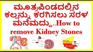 how to remove kidney stones naturally..home remedies to dissolve kidney stones.