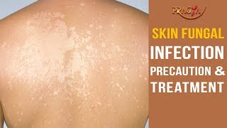 Watch Skin Fungal Infection Precaution and Treatment