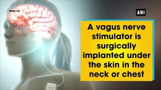 Can nerve stimulation benefit depressed patients