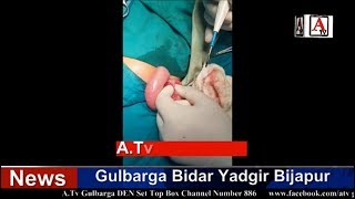 Gulbarga Ke KBN Hospital Mein Anokha Operation A.Tv News 29-8-2018