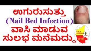 Home Remedies for Uguru Suttu in Kannada | Whitlow | Nail Bed Infection | Kannada Sanjeevani