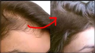Magical Hair Serum - Grow Long, Thick Hair | JSuper kaur