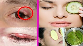 Home Remedies to Get Rid of Stye Fast, Safely and Naturally | Telugu Health Tips |