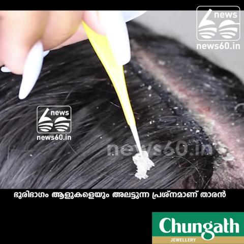 how to deal with dandruff; preventive methods