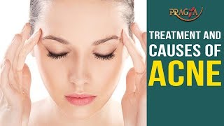 Watch Treatment and Causes of Acne | Skin Care Tips