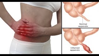 এপেন্ডিসাইডের লক্ষন ও চিকিৎসা | Symptoms and treatment of appendix side | abdominal pain
