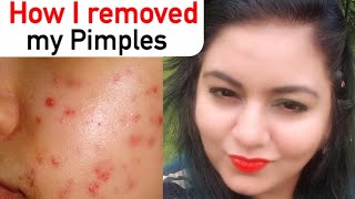 Skin Care Routine for Acne Prone Skin for fighting Pimples, Dark Spots | JSuper Kaur