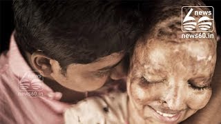 Indian acid attack survivor finds love while in hospital