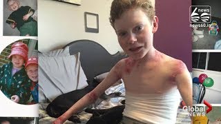 'Butterfly boy' saved from debilitating illness after doctors create new skin