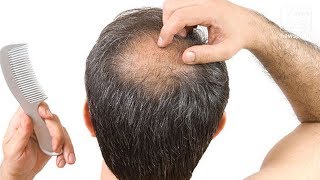 Early Balding and Gray Hair Linked to Heart Disease