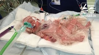 'Miracle baby' born with heart outside body is first to survive in UK