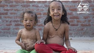 Indian siblings suffer from rare condition that makes them look 'old'