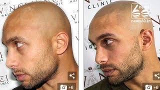 Bald men turn to hair tattoos to creates the illusion of short hair