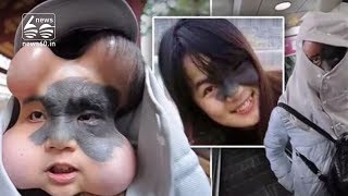 Woman has four balloons implanted in her face so dangerous birthmark can removed and replaced
