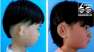 5 Chinese children get new ears grown from own cells