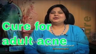 Reason and cure of adult Acne Tips by expert dermatologist मुहासों के वजह और उसका इलाज
