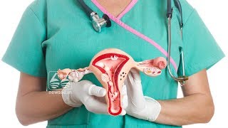 Polycystic Ovarian Disease Diagnosis and Treatment