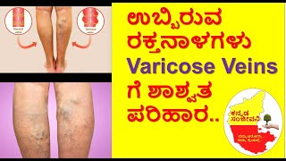 How to Cure Varicose Veins Permanently in  Kannada | Spider Veins treatment | Kannada Sanjeevani