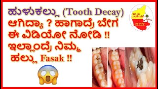 5 ನಿಮಿಷದಲ್ಲೇ  ಹುಳುಕಲ್ಲು ವಾಸಿಮಾಡುವ ಸೂಪರ್ ಮನೆಮದ್ದು | Remove Tooth Decay | Kannada Sanjeevani