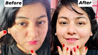 Pimples Treatment 100% with Proof | JSuper Kaur