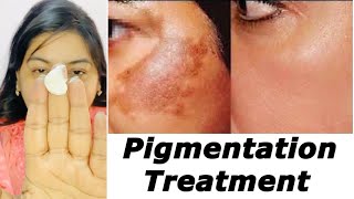 Home Treatment for Pigmentation, Acne Pits | JSuper Kaur