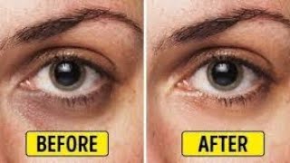 How to remove Dark Circle & Puffy Eyes | JSuper Kaur