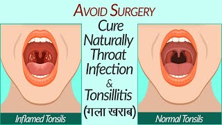 What are Tonsils - Cure Tonsillitis Sore throat naturally - जानिए इसका कुदरती इलाज बगैर ऑपरेशन