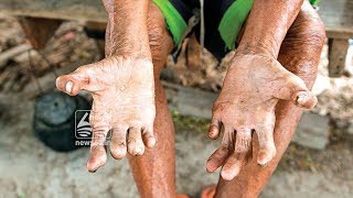 leprosy spread in thrissur