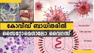 കോവിഡ് ബാധിതരിൽ സൈറ്റോമെഗാലോ വൈറസ്...Cytomegalovirus in covid victims