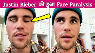 Justin Bieber Ko Hua Face Paralysisi, Fans Hue Pareshaan