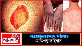 করোনা ভাইরাসের পর এবার; মাঙ্কিপক্স ভাইরাস | MONKEY POX Virus | Ananda TV news
